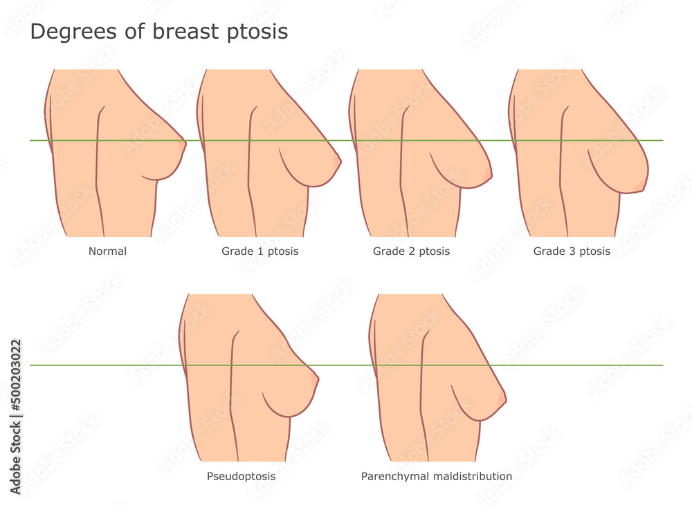 Types of breast ptosis medical vector illustration. Stock Vector
