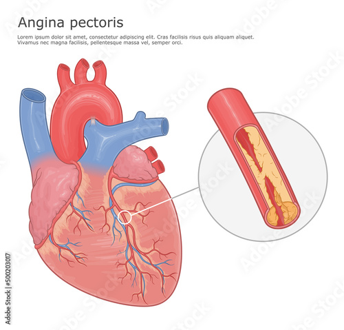 Angina pectoris medical vector illustration. Human heart and blocked artery with plague close up.  