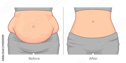 Woman's belly before and after weight loss. Vector illustration. photo