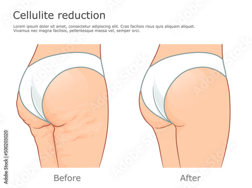 Cellulite and healthy skin vector illustration. Before and after reduction procedure. 