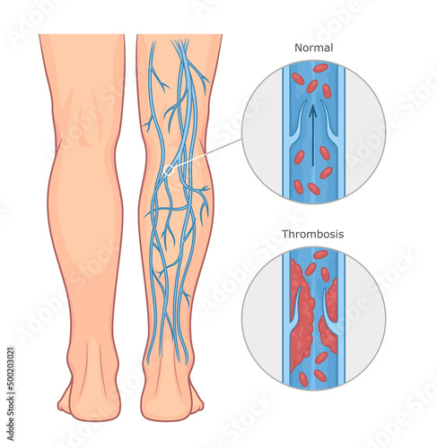 Deep vein thrombosis or DVT vector medical illustration. Healthy and unhealthy vein.  photo
