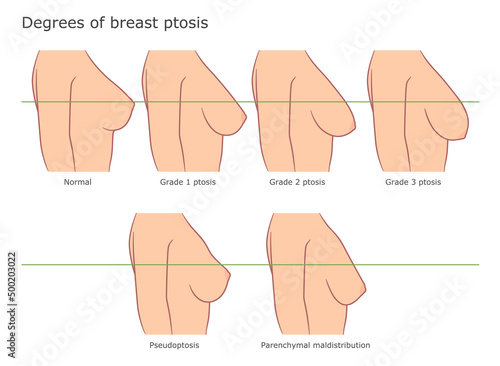 Types of breast ptosis medical vector illustration. 