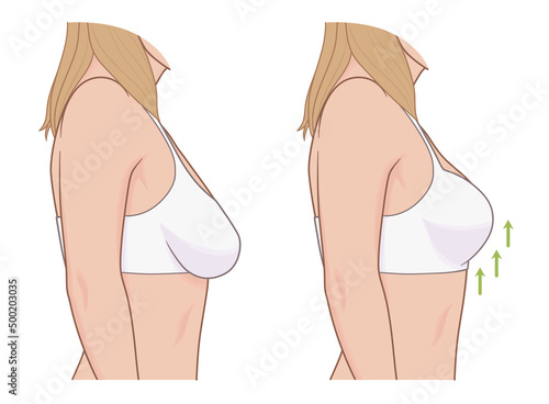 Woman breast ptosis before and after correction. 