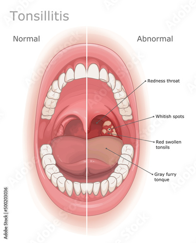 Tonsillitis medical illustration. Normal oral cavity and tonsillitis symptoms labeled.  photo