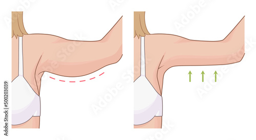 Woman hands fat loss illustration before and after exercises. 
