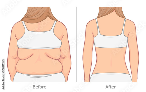 Back weight loss illustration. Woman's back before and after weight loss. 