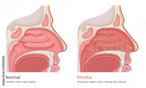 Rhinitis medical illustration. Normal nasal cavity and rhinitis symptoms.