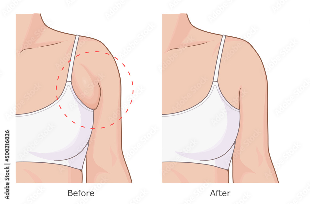 Reduce armpit fat illustration. Woman armpit fat loss vector illustration.  Before and after. Stock Vector