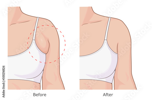Reduce armpit fat illustration. Woman armpit fat loss vector illustration. Before and after.