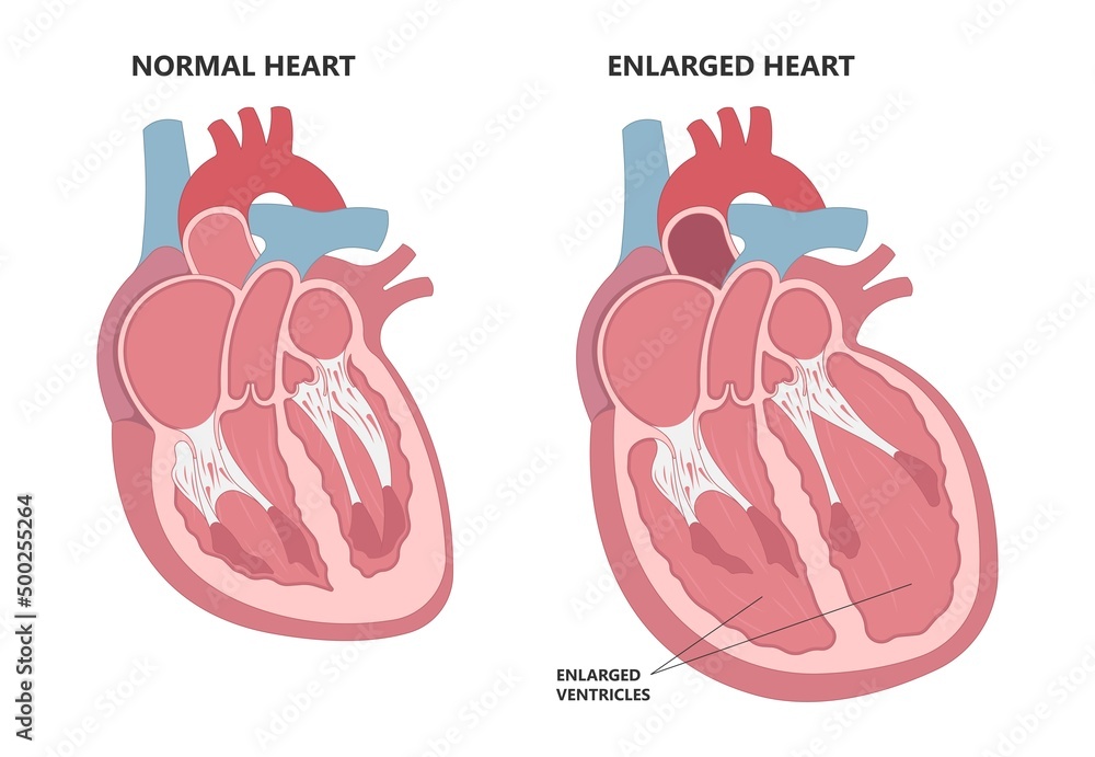 Enlarged Athlete's Heart Angina X-ray Edema Test Diagnose Chest Pain 