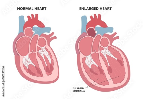 Enlarged athlete's heart angina x-ray edema test diagnose chest pain high blood pressure sudden death shock stress test