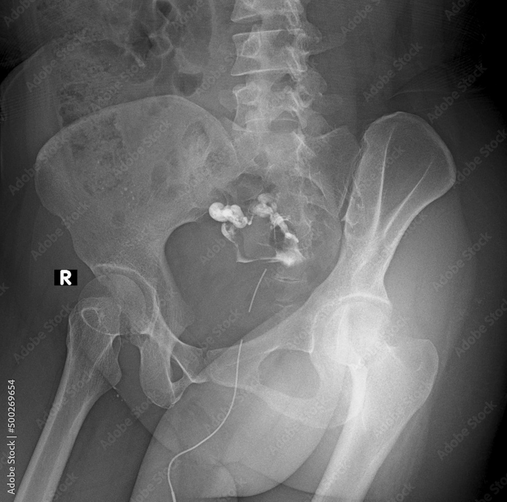 xray image of partial obstruction Hysterosalpingography (HSG) Stock