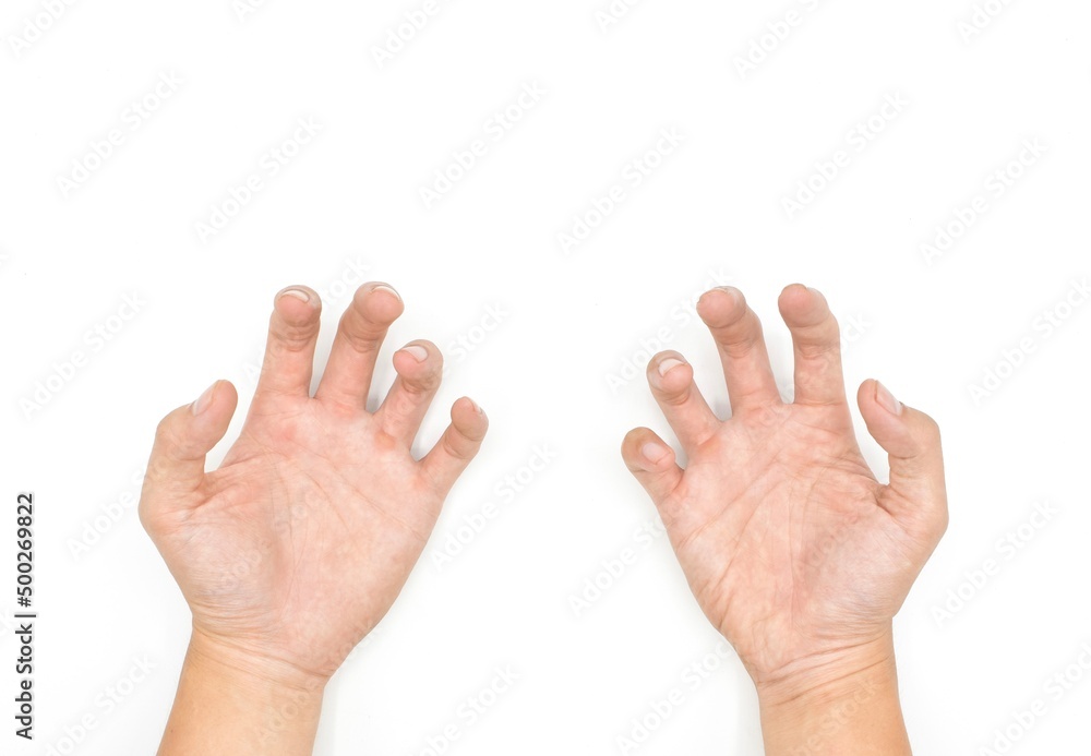 Volkmann contracture in Southeast Asian young man. Volkmann contracture in Southeast Asian young man.