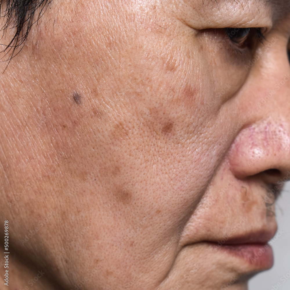 Small brown patches called age spots on face of Asian elder man. They are also called liver spots, senile lentigo, or sun spots. Small brown patches called age spots on face of Asian elder man. They are also called liver spots, senile lentigo, or sun spots.