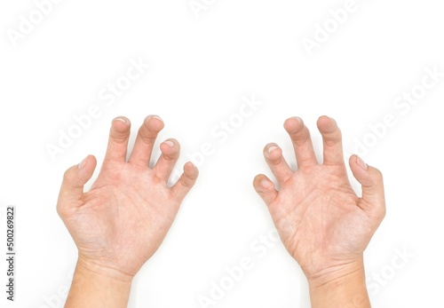Foto Volkmann contracture in Southeast Asian young man.