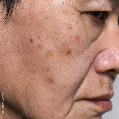 Small brown patches called age spots on face of Asian elder man. They are also called liver spots, senile lentigo, or sun spots. photo