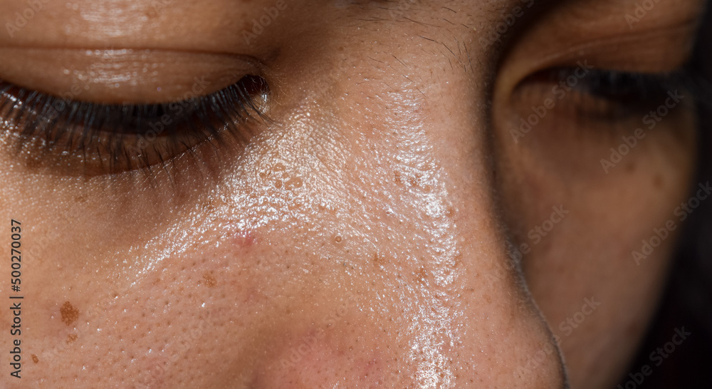 Fototapeta premium Whiteheads and pimples on oily face of Asian woman.