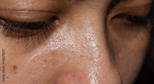 Whiteheads and pimples on oily face of Asian woman. photo