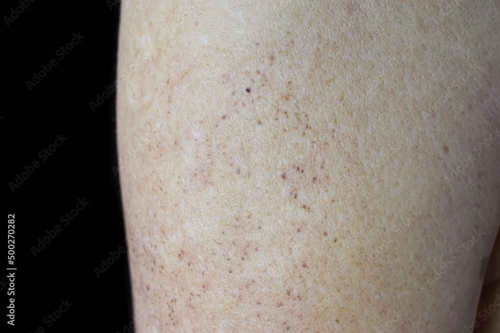 Age spots and white patches on the arm. They are brown, gray, or black