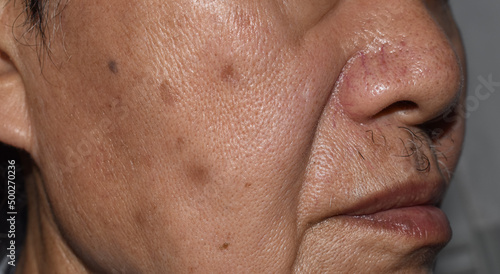 Small brown patches called age spots on face of Asian elder man. They are also called liver spots, senile lentigo, or sun spots. photo