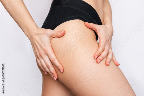 Cropped shot of a young woman with white stretch marks from a weight loss or weight gain on her thigh isolated on a white background. Changes in the body. Cosmetology, beauty photo