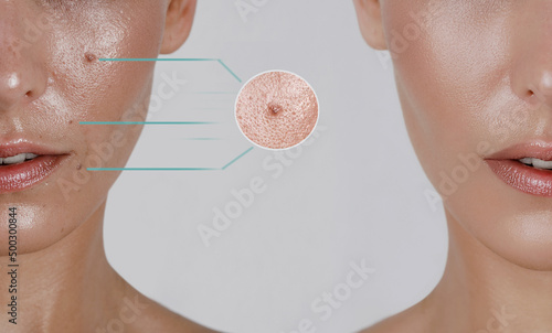 before and after excision of a nevus spots on a woman's cheek with a laser in a cosmetology clinic, close-up, details