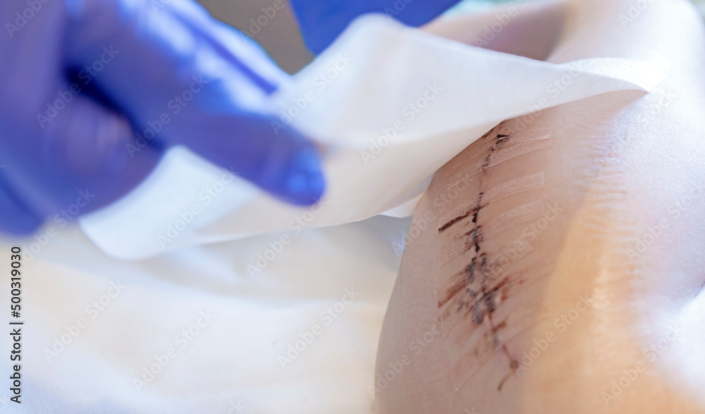 The doctor applies a patch to the scar after surgery on the child's leg. Antibacterial patch. - obrazy, fototapety, plakaty 