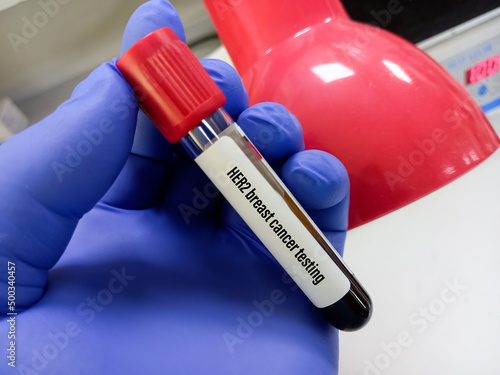 Blood sample for Her-2 breast cancer testing, human epidermal growth factor receptor 2(HER2), ERBB2 Amplification. photo