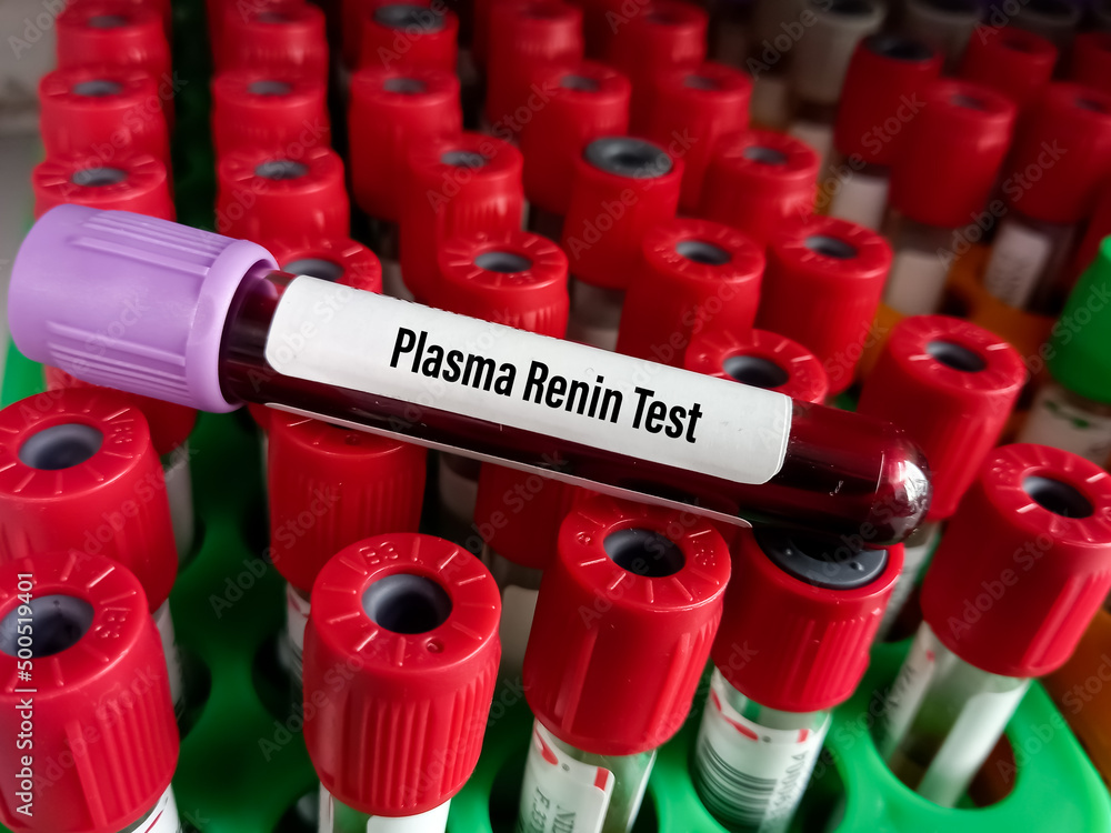 Blood sample for Direct renin test to diagnose adrenal gland disorder