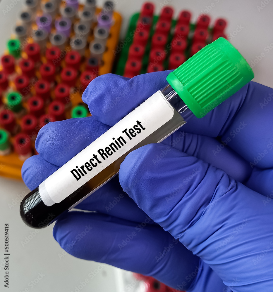 Blood sample for Direct renin test to diagnose adrenal gland disorder