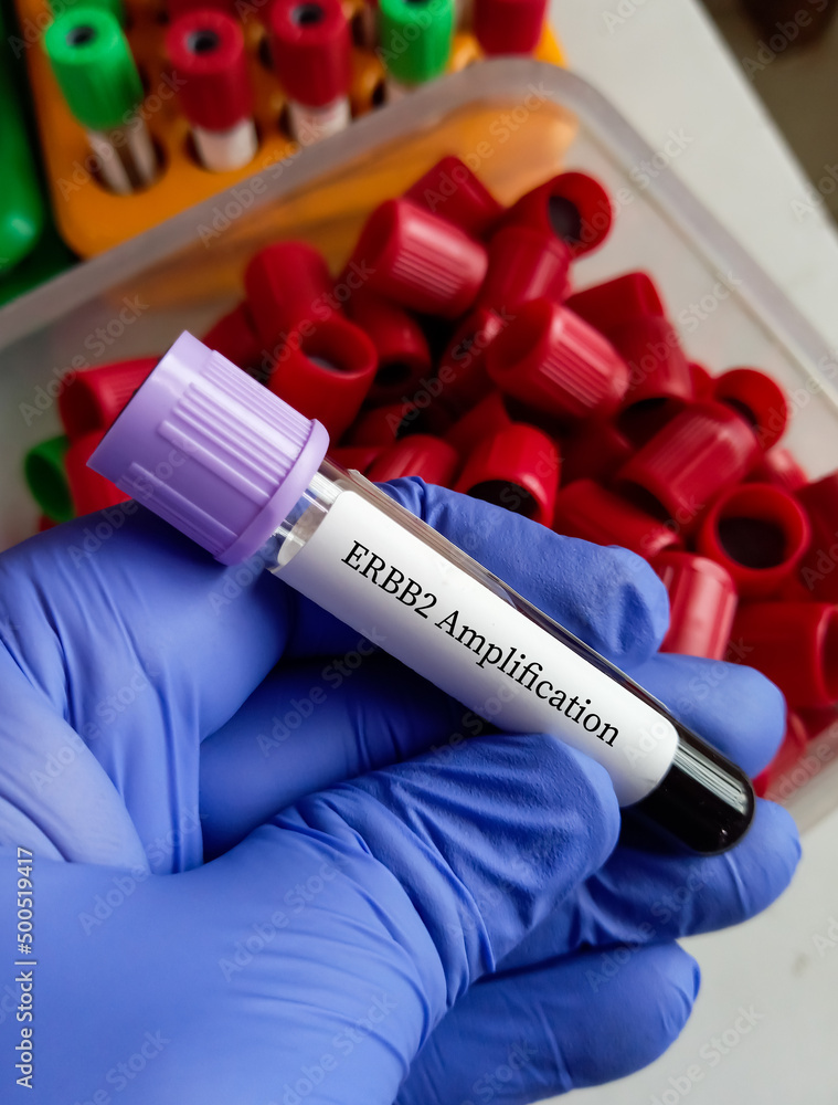 Blood sample for ERBB2 Amplification, diagnosis of breast cancer, human Blood sample for ERBB2 Amplification, diagnosis of breast cancer, human