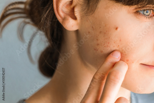 Woman with red cheeks- diathesis or allergy symptoms. Redness and peeling of the skin on the face. Teenage girl with acne problem on beige background, closeup. photo