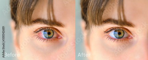 Red eye before and after treatment. Tired eyes and contact lenses. Close up. Dry eye before and after the use of eye drop.