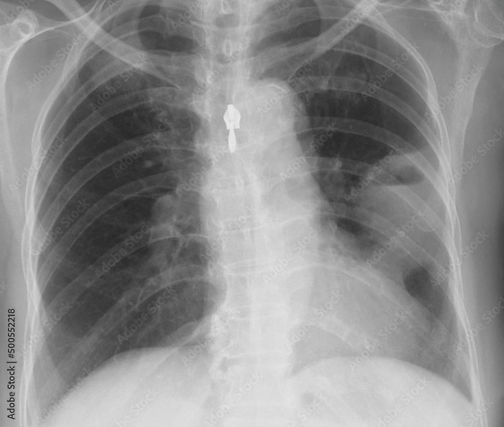 chest x-ray image of lung abscess chest x-ray image of lung abscess