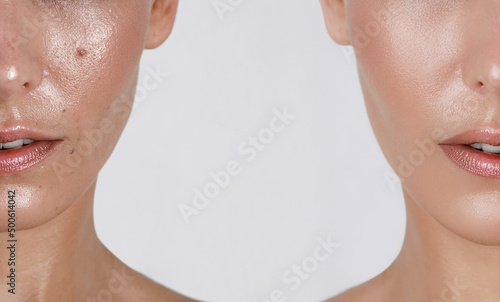 close-up girl with hyperhidrosis on her face and excessive oily sheen, with enlarged pores and nevus. before and after treatment with botulinum toxin injections photo