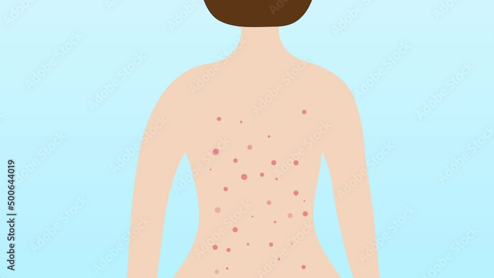 Acne on female back. Allergy treatment, skin problems concept. Acne on female back. Allergy treatment, skin problems concept.