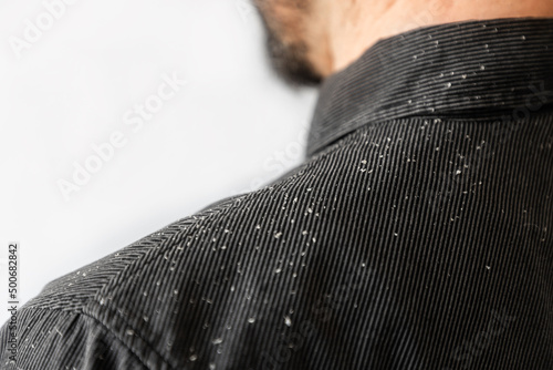 A bearded man in a black shirt, a close up view of the shoulder covered with dandruff. Copy space. The concept of psoriasis and seborrheic dermatitis photo
