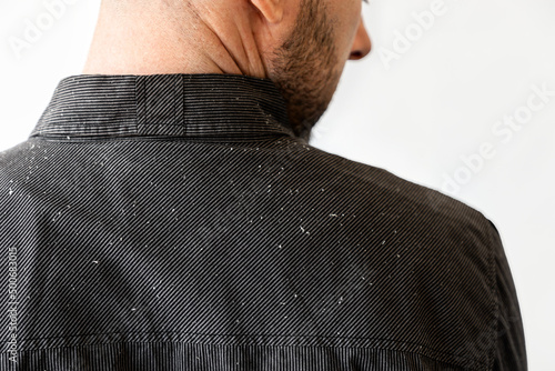 Vászonkép Close up view of man's shoulders in black shirt covered with dander