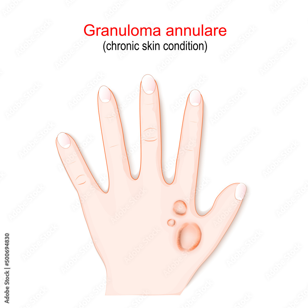 Fototapeta premium Granuloma annulare. Chronic skin condition.