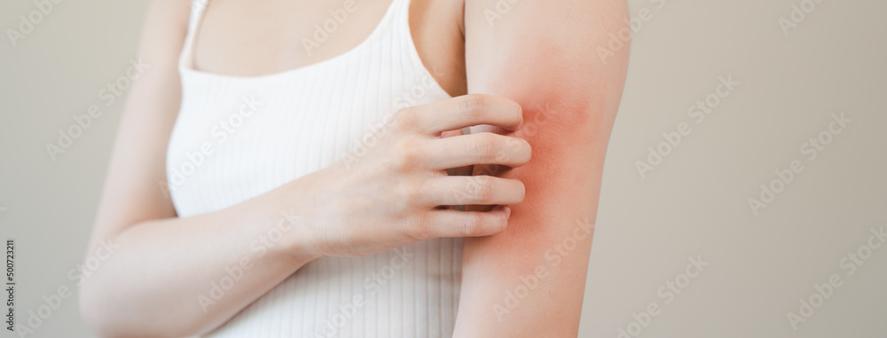 Sensitive skin allergic concept, Woman itching on her arm have a red ...