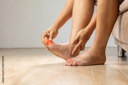 Fototapeta Senior Man massage foot with painful swollen gout inflammation