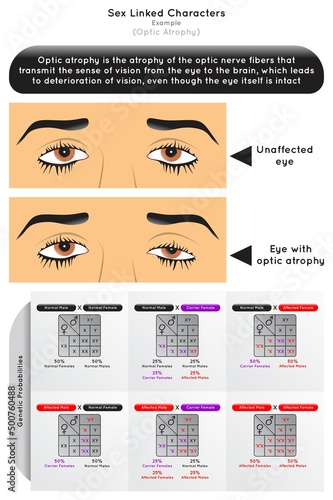 Sex Linked Characters Infographic Diagram example optic atrophy nerve fiber sense of vision eye to brain visual deterioration punnett square genetic probability heredity gene science education vector
