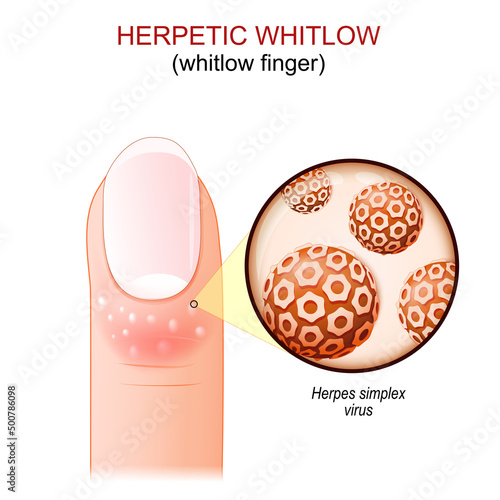 Herpetic whitlow. whitlow finger.