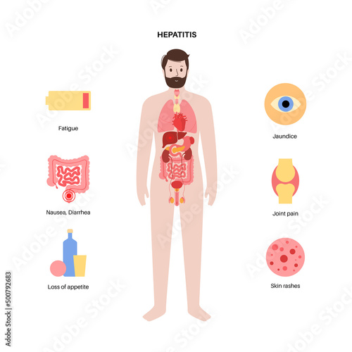 Autoimmune hepatitis disease