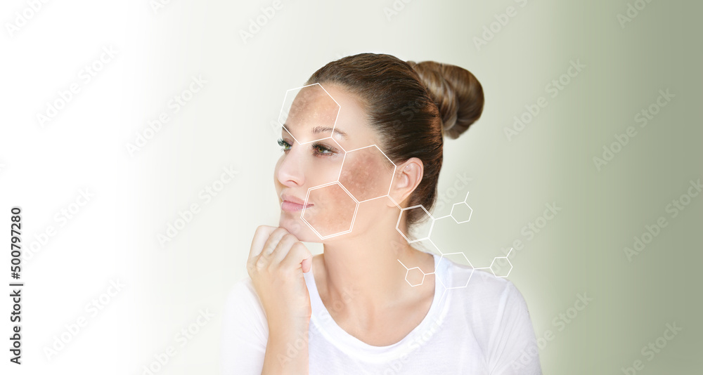 Dark spots, freckles,hyperpigmentation(melasma or chloasma),concept - skin lightening, skin whitening, fruit acids,AHA, Skin Brightening Dark spots, freckles,hyperpigmentation(melasma or chloasma),concept - skin lightening, skin whitening, fruit acids,AHA, Skin Brightening
