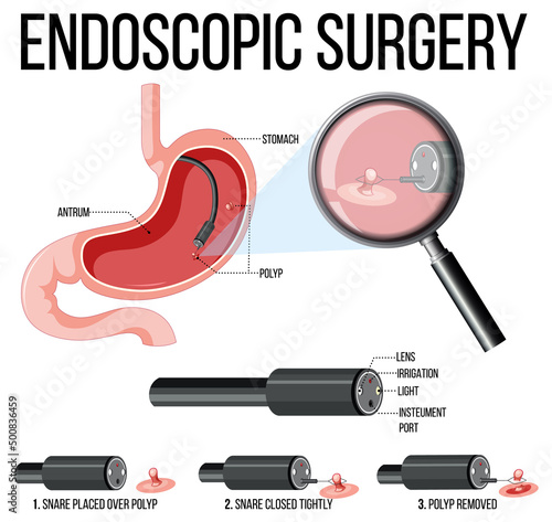 Diagram showing endoscopic surgery