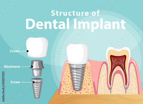 Infographic of human in structure of the dental implant