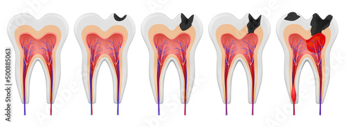 Stages of caries development in a human molar. Healthy tooth. Dental diseases of the teeth: enamel, dentin, deep caries, pulpitis, periodontitis. 3d illustration photo