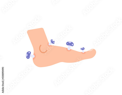 illustration of foot overgrown or infected by fungus. fungal skin disease. health problem. flat cartoon. design elements. human body parts
