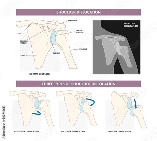 Shoulder dislocation X-ray joint arm sport lesion slap hill sachs tear torn traumatic pain broken cuff sling bone falls tendon subluxed head range of motion Superior overuse clavicle separated therapy